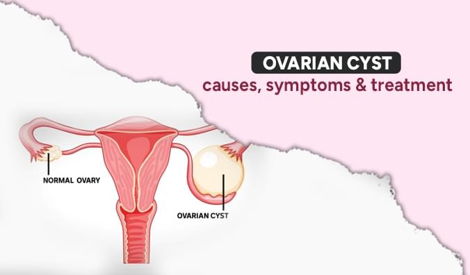 Fertility treatment at Aakash Fertility Centre Chennai — IVF specialists since 1991